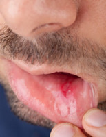 Summary of mouth ulcer
